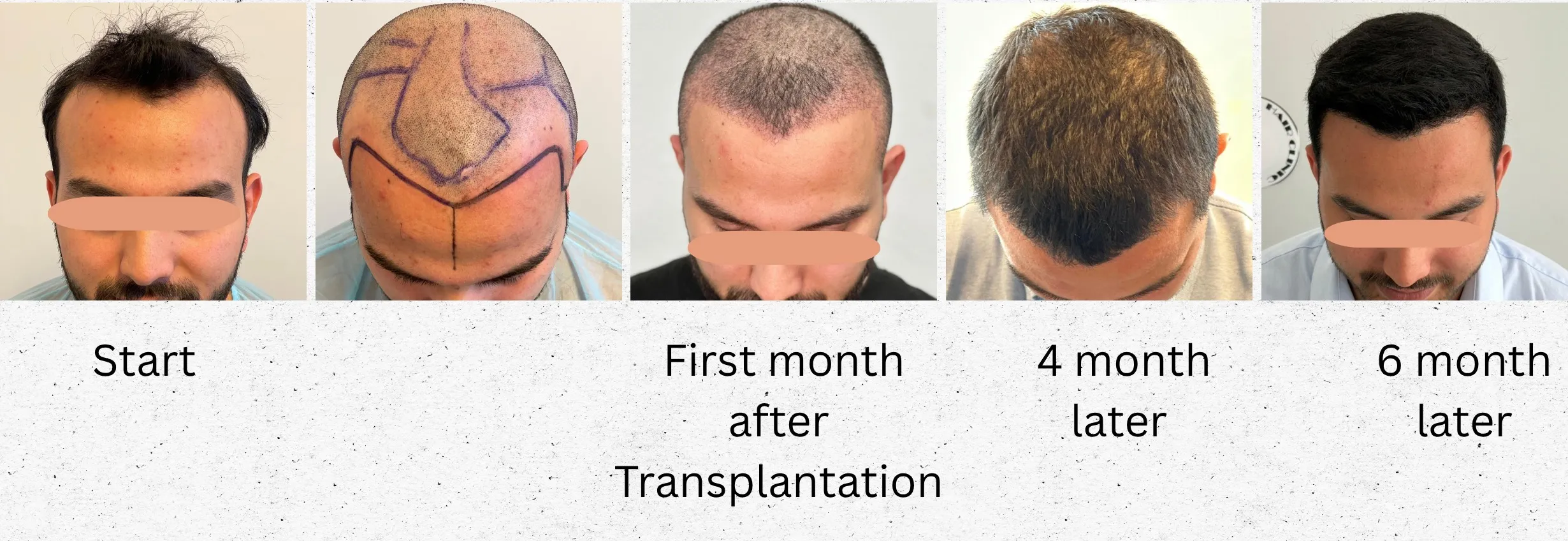 Der Haaransatz eines AS-Clinic-Patienten, fotografiert zu Beginn, nach einem Monat, nach vier Monaten und nach sechs Monaten nach einer FUE-Haartransplantation